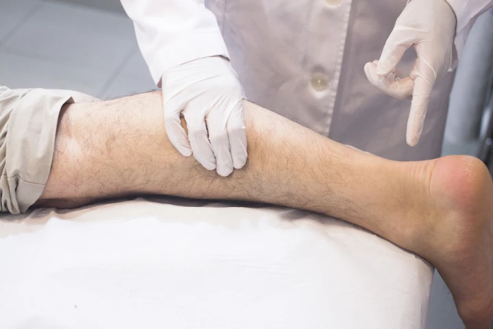 A Simple Understanding of Varicose Veins A Simple Understanding of Varicose Veins